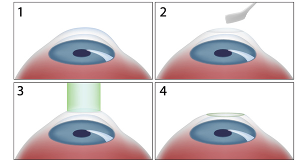 reabilitare miopie chirurgie oculară)