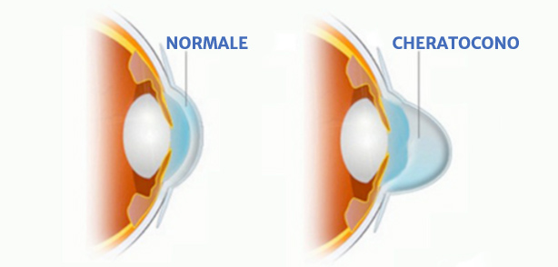 Cheratocono